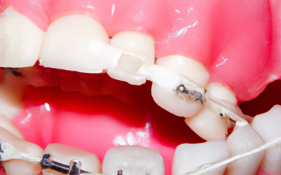 How to Fix Broken Braces