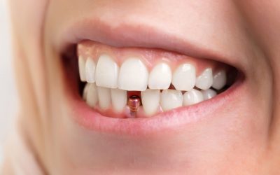 What Should I Do If My Temporary Dental Crown Or Filling Falls Out?